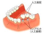 インプラント