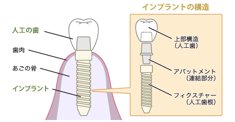 インプラントの構造