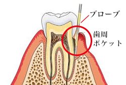 歯周ポケット