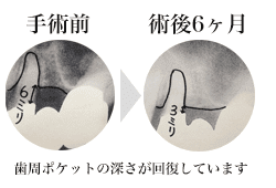 歯周ポケットが回復