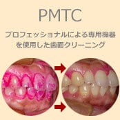 PMCT