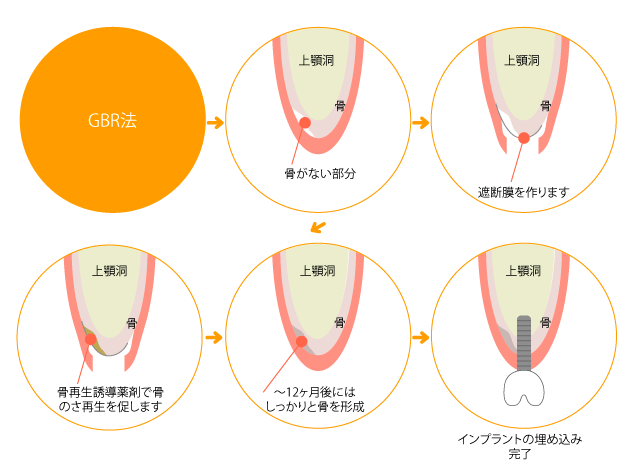 GBRの歯科インプラントへの応用 sddefault.jpg